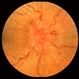 Optic Disc Edema and Hemorrhages with Subdural Hematoma Optic Disc Edema and Hemorrhages with Subdural Hematoma